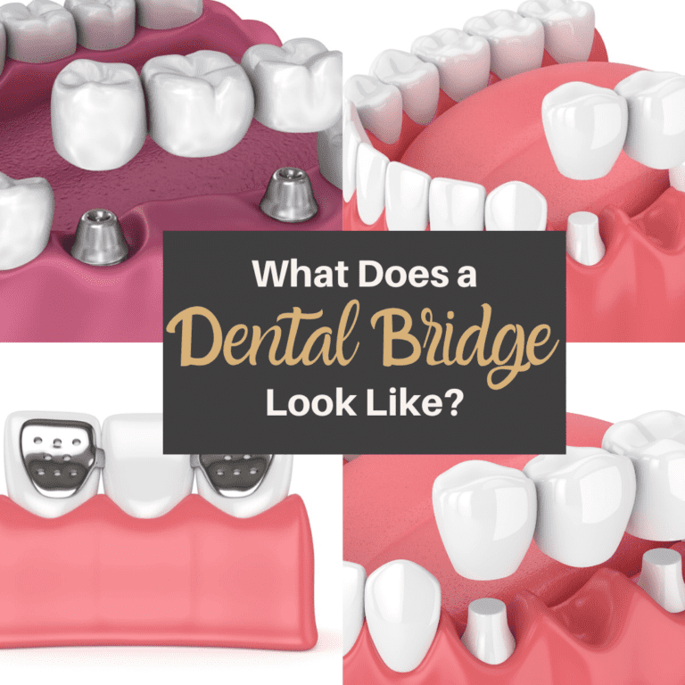 What Does a Dental Bridge Look Like?